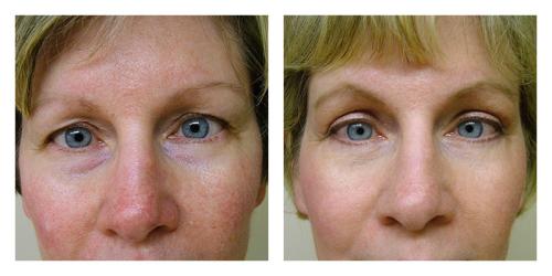 Blepharoplasty result at Smith Plastic Surgery