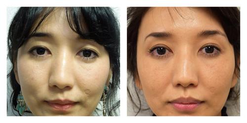 A result from Smith Plastic Surgery