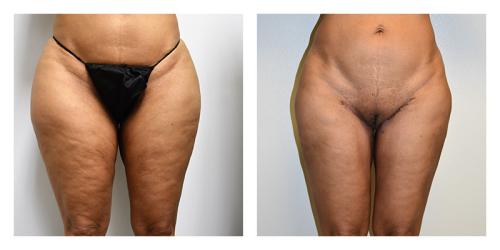 A result from Smith Plastic Surgery