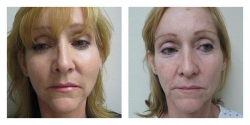 Facelift result at Smith Plastic Surgery