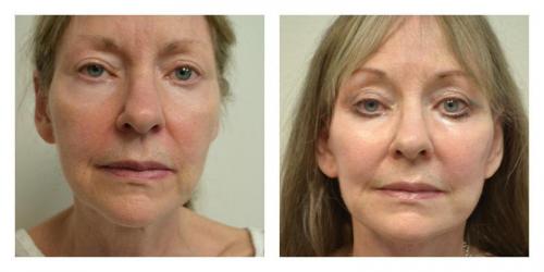 Facelift result at Smith Plastic Surgery