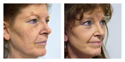 Facelift result at Smith Plastic Surgery