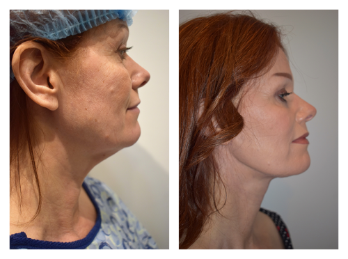 Neck Lift result at Smith Plastic Surgery