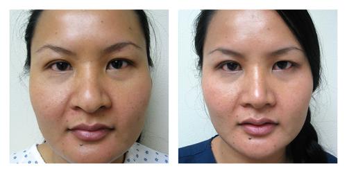 Rhinoplasty result at Smith Plastic Surgery