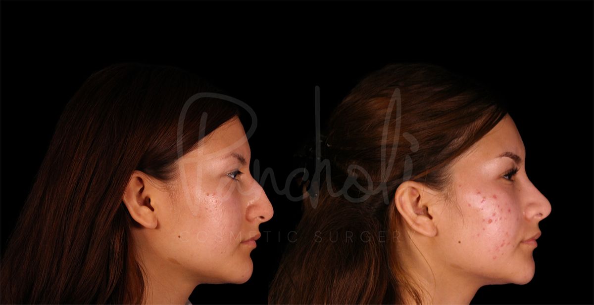 Pancholi Cosmetic Surgery rhinoplasty result — Las Vegas, NV