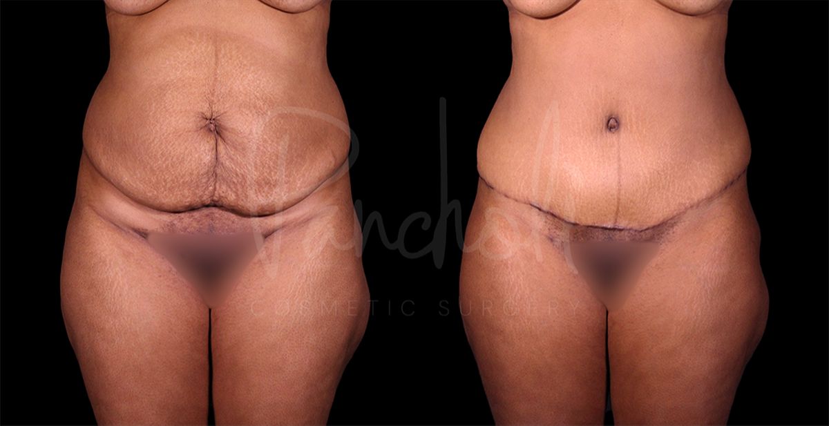 Tummy Tuck result at Pancholi Cosmetic Surgery