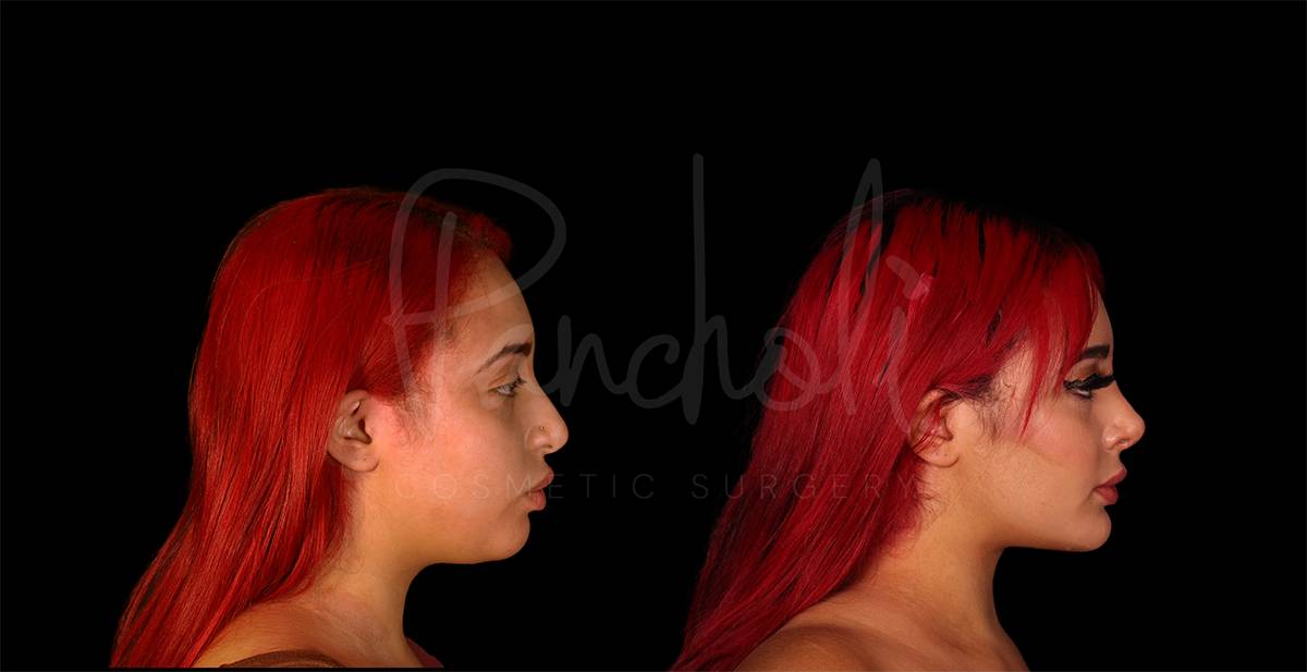 Pancholi Cosmetic Surgery neck lift result — Las Vegas, NV
