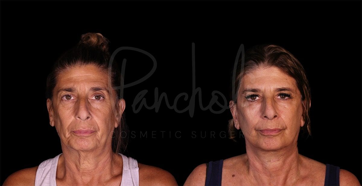 Pancholi Cosmetic Surgery facelift result — Las Vegas, NV