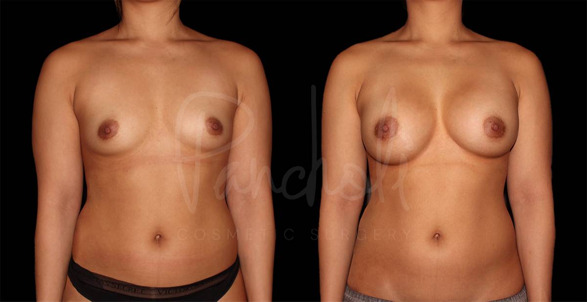 Breast Augmentation result at Pancholi Cosmetic Surgery