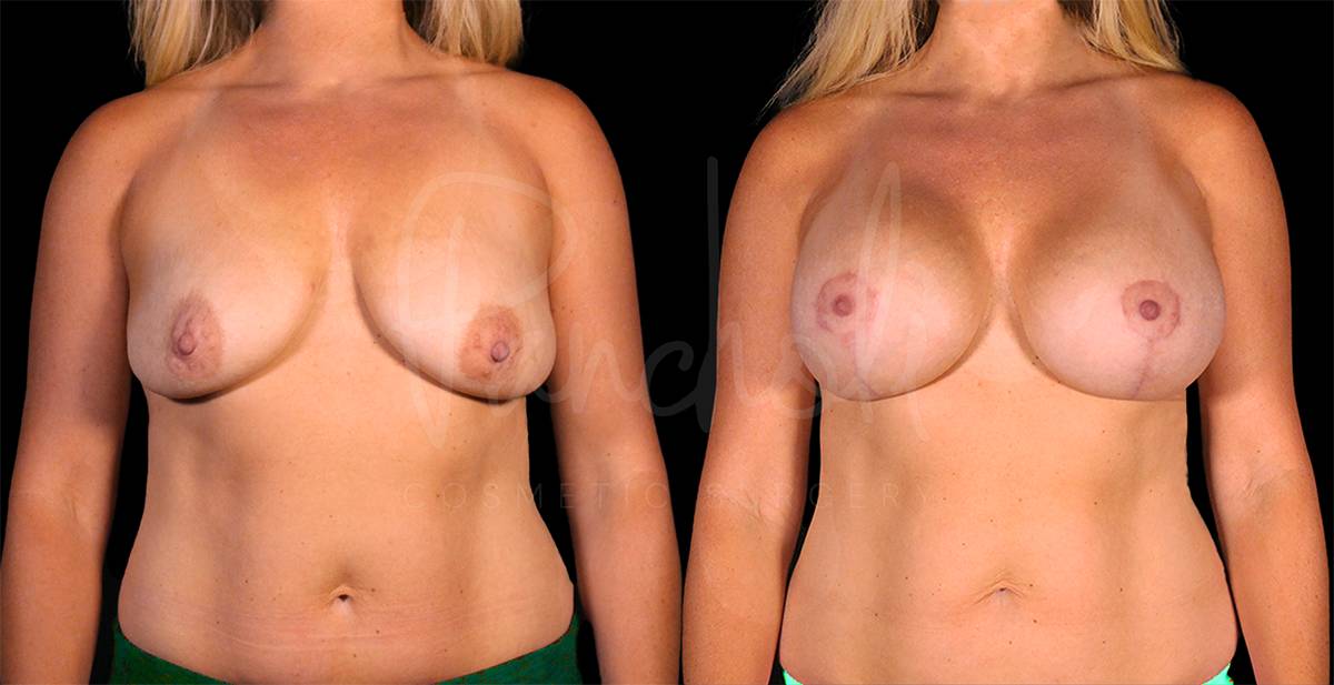 Pancholi Cosmetic Surgery breast lift result — Las Vegas, NV