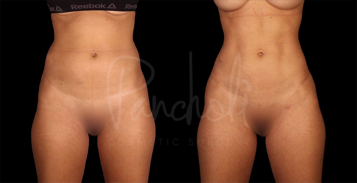 Pancholi Cosmetic Surgery liposuction result — Las Vegas, NV