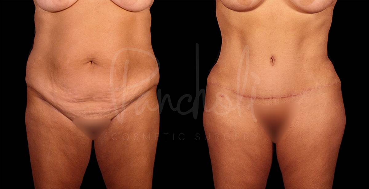 Tummy Tuck result at Pancholi Cosmetic Surgery