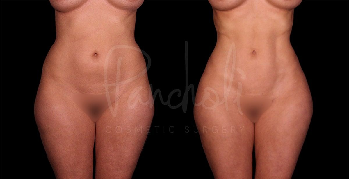 Pancholi Cosmetic Surgery liposuction result — Las Vegas, NV