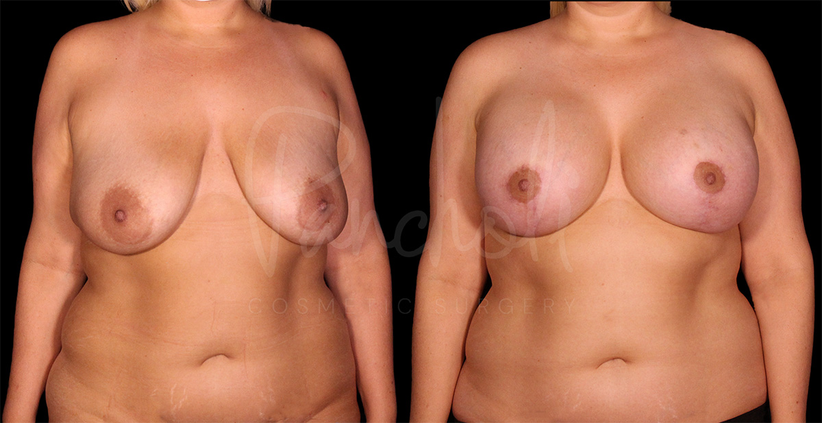 Pancholi Cosmetic Surgery breast lift result — Las Vegas, NV