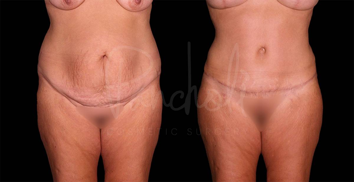 Tummy Tuck result at Pancholi Cosmetic Surgery