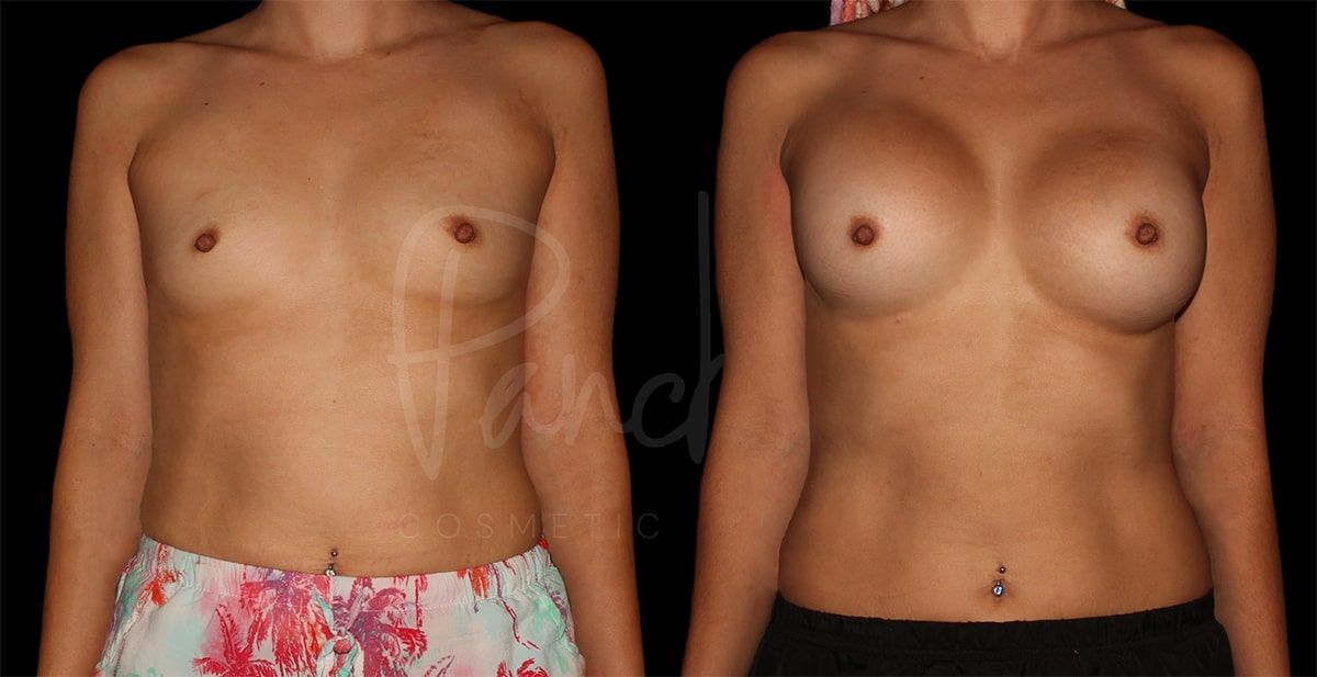 Breast Augmentation result at Pancholi Cosmetic Surgery