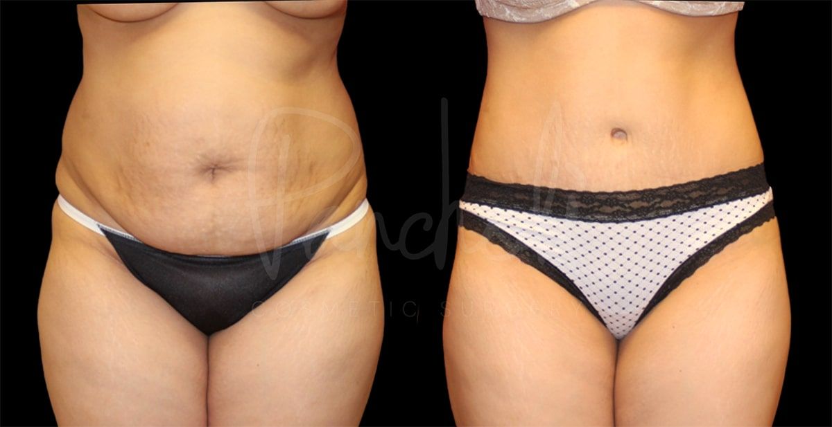 Tummy Tuck result at Pancholi Cosmetic Surgery