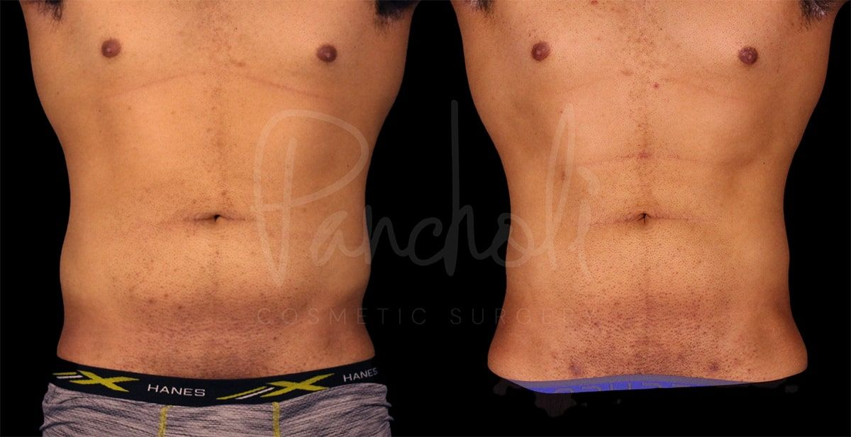 Pancholi Cosmetic Surgery liposuction result — Las Vegas, NV