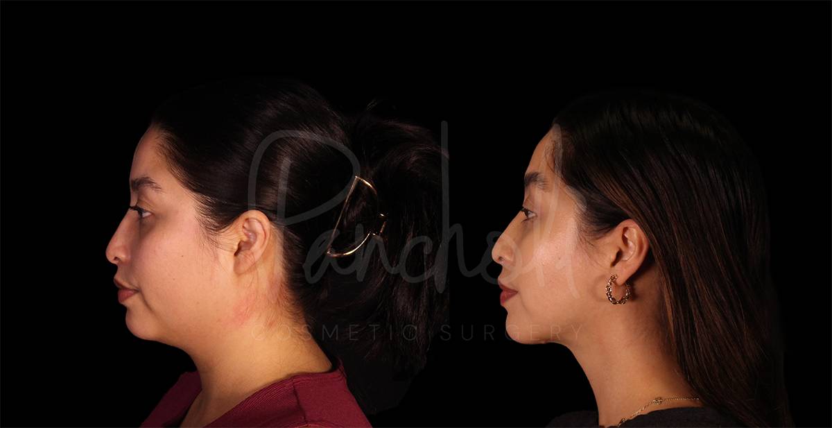 Pancholi Cosmetic Surgery neck lift result — Las Vegas, NV