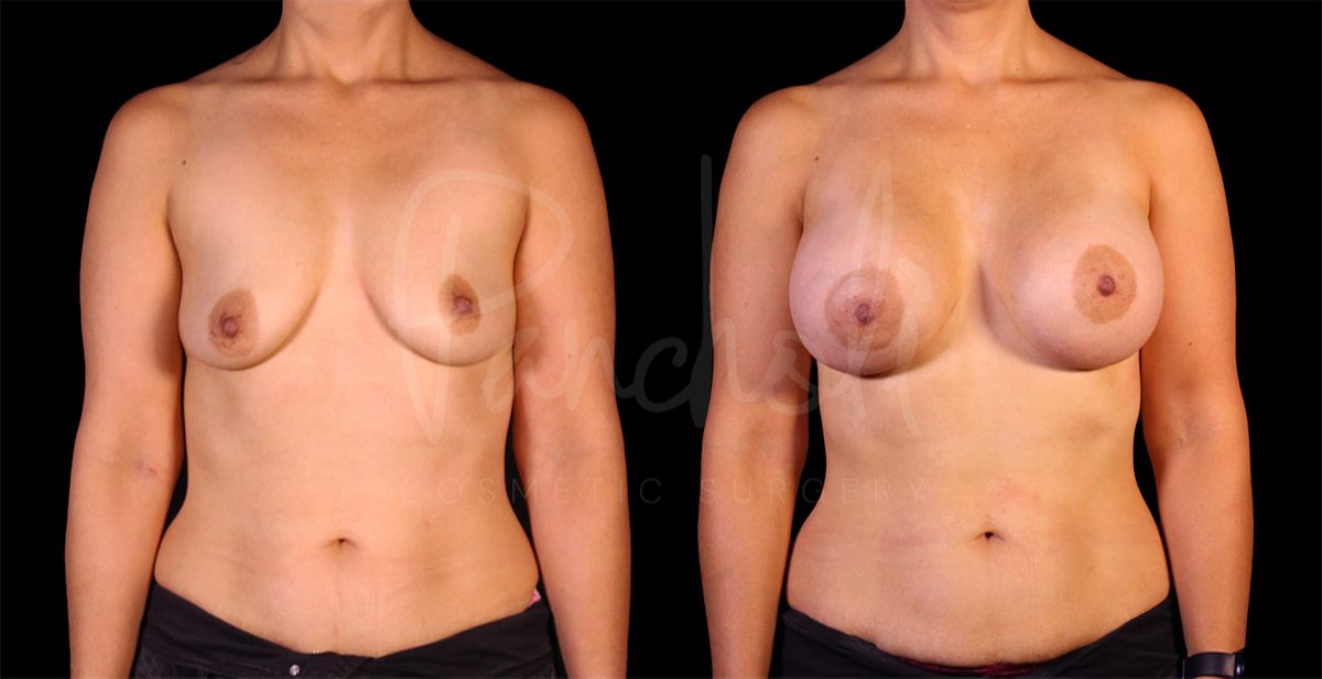Breast Augmentation result at Pancholi Cosmetic Surgery