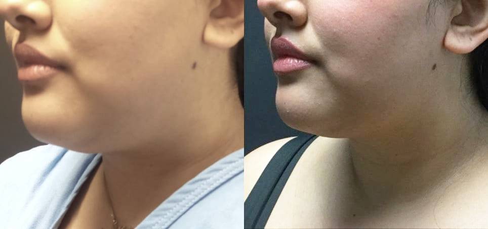 A result from Blaine Plastic Surgery