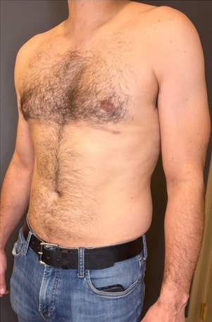 A result from Village Plastic Surgery (Pedy Ganchi, MD)