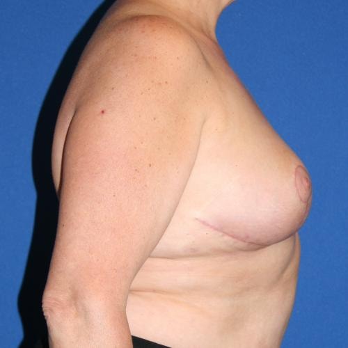 A result from North Coast Plastic Surgery