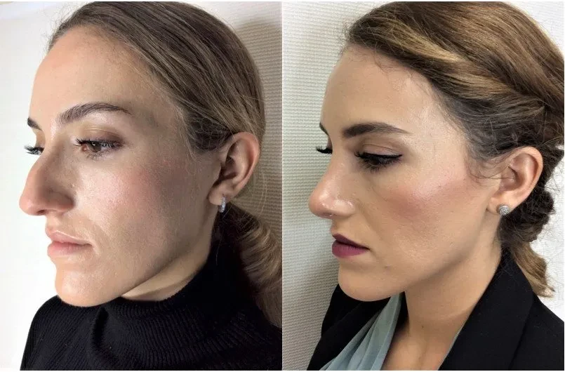 A result from Masri Clinic for Laser and Cosmetic Surgery