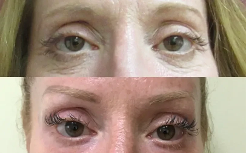 A result from Masri Clinic for Laser and Cosmetic Surgery