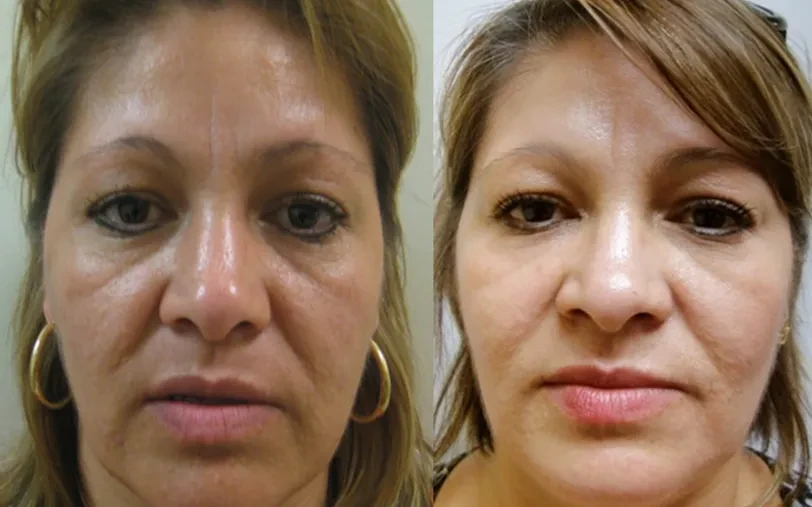A result from Masri Clinic for Laser and Cosmetic Surgery