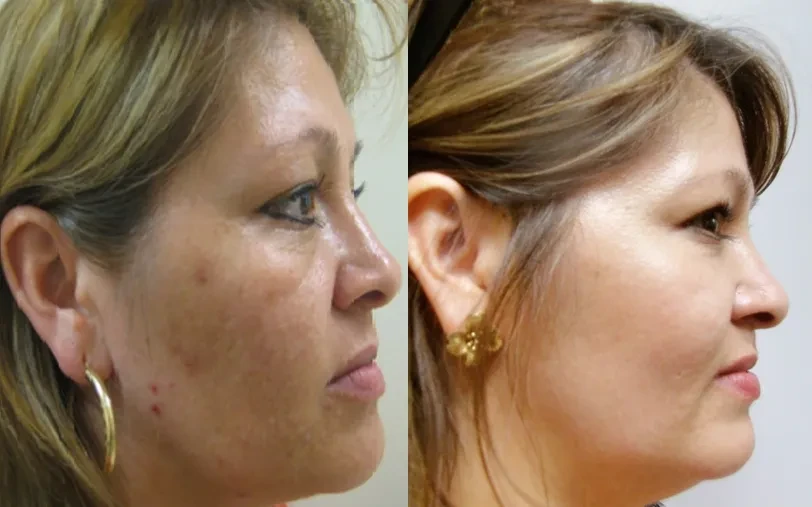 A result from Masri Clinic for Laser and Cosmetic Surgery