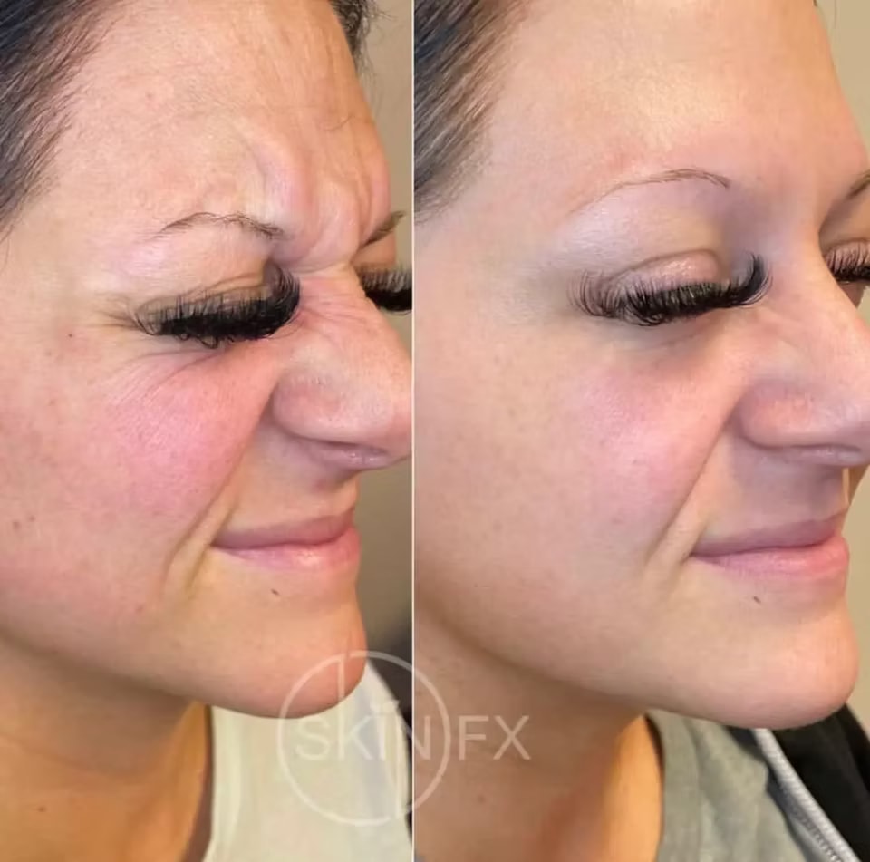 A result from SkinFX Med Spa