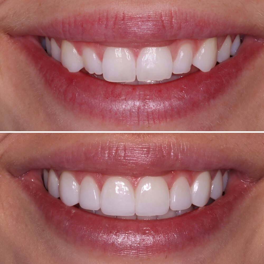 Chase Inspired Dentistry veneers after — Salt Lake City, UT