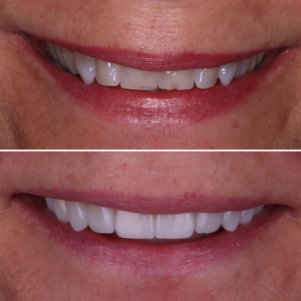 Chase Inspired Dentistry dental veneers result