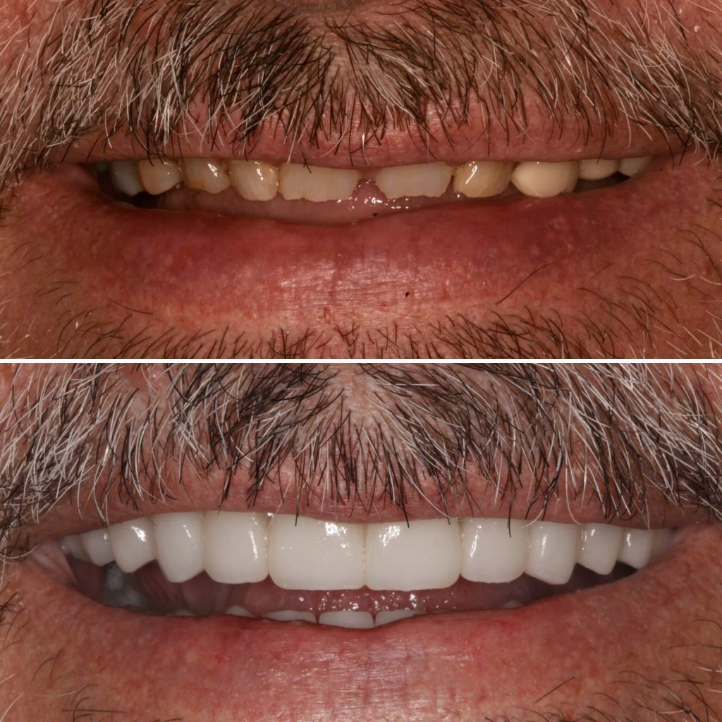 Chase Inspired Dentistry veneers after — Salt Lake City, UT