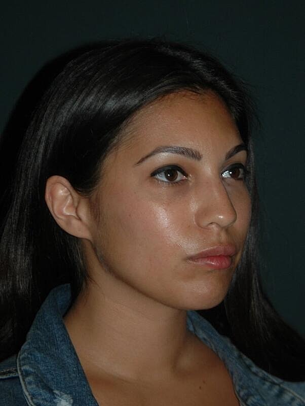 A result from Malone Facial Plastic Surgery