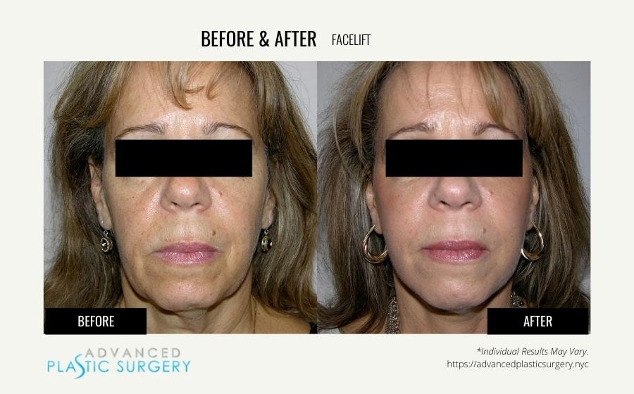 A result from Advanced Plastic Surgery (Scarsdale)