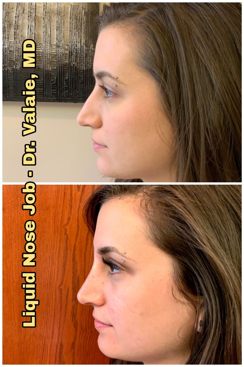 A result from Dr. Valaie, MD - Cosmetic Surgeon