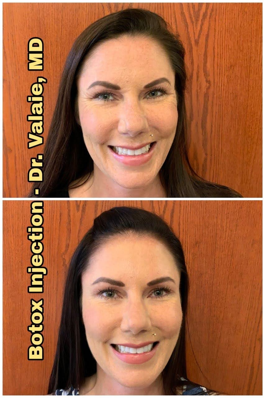 A result from Dr. Valaie, MD - Cosmetic Surgeon