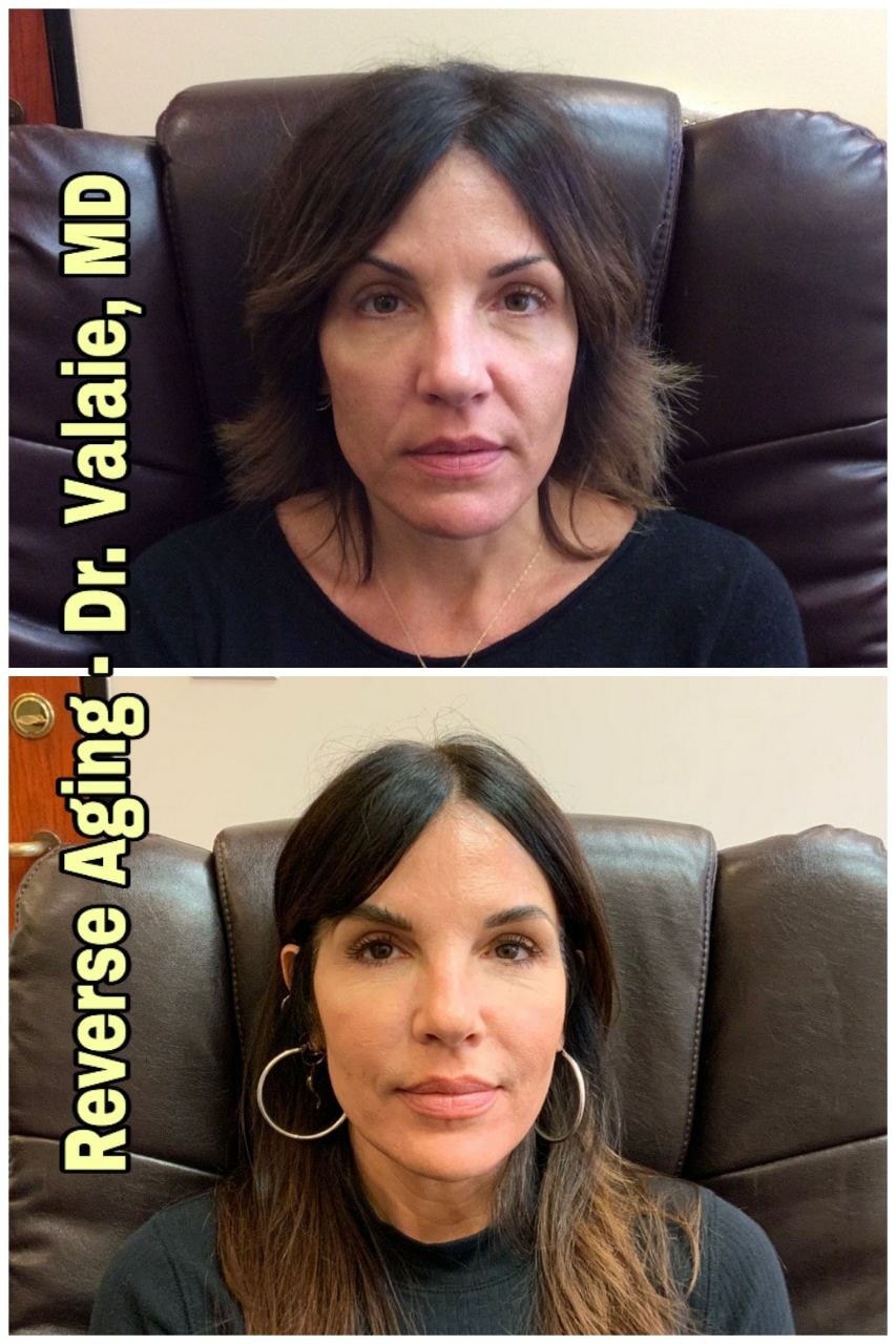 A result from Dr. Valaie, MD - Cosmetic Surgeon
