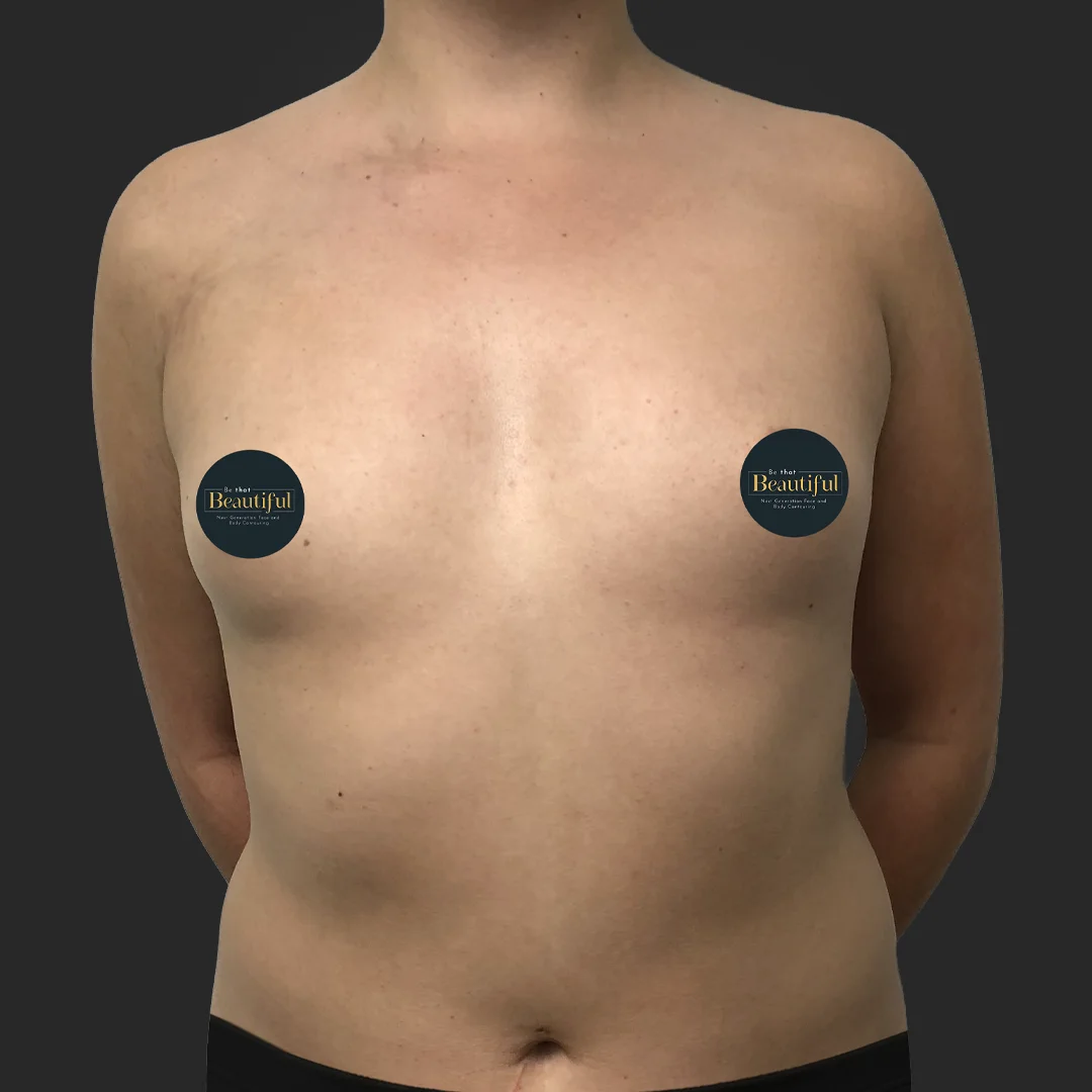 Breast Augmentation result at Be That Beautiful™ Plastic Surgery