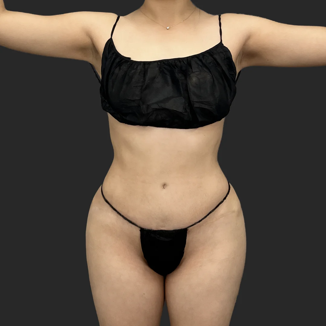 Tummy Tuck result at Be That Beautiful™ Plastic Surgery