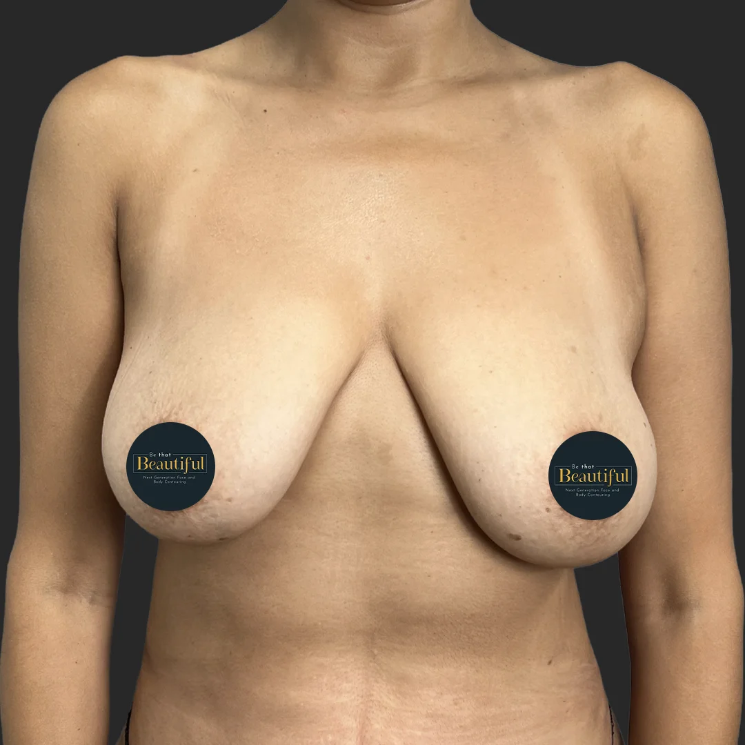 Mommy Makeover result at Be That Beautiful™ Plastic Surgery