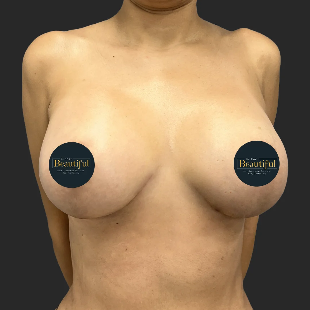 Mommy Makeover result at Be That Beautiful™ Plastic Surgery