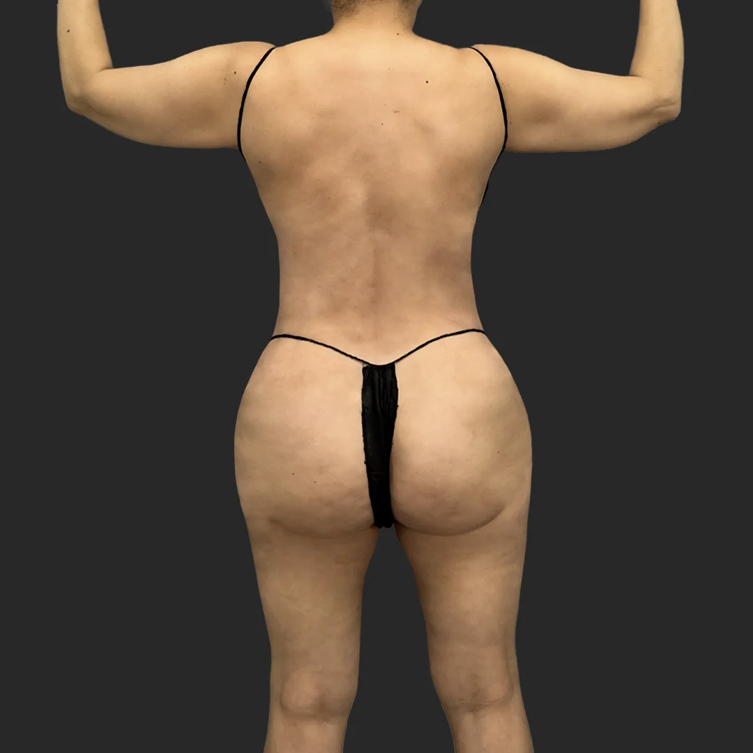 Tummy Tuck result at Be That Beautiful™ Plastic Surgery