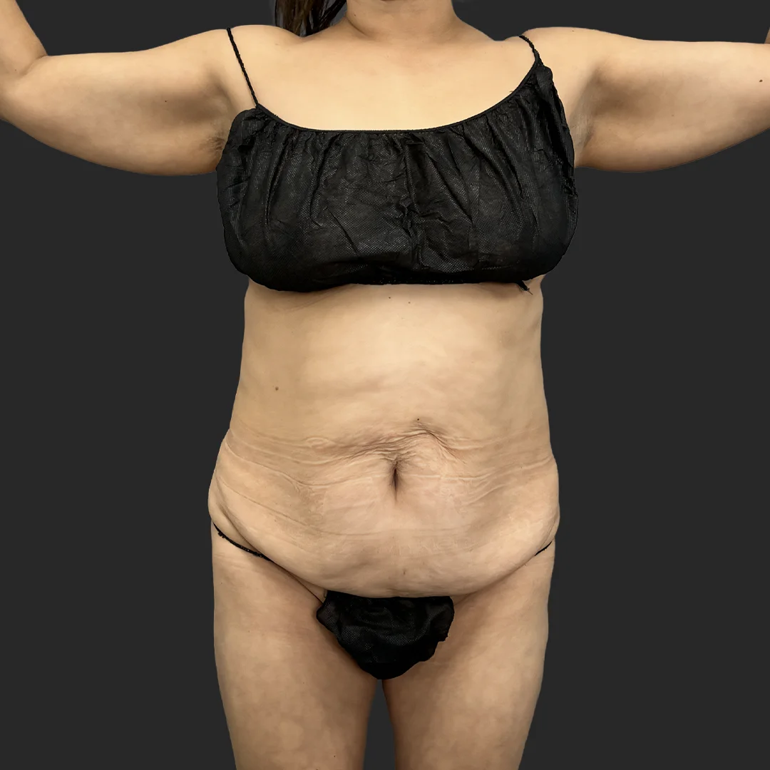 Tummy Tuck result at Be That Beautiful™ Plastic Surgery