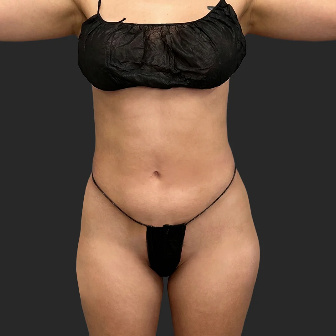 Bbl result at Be That Beautiful™ Plastic Surgery