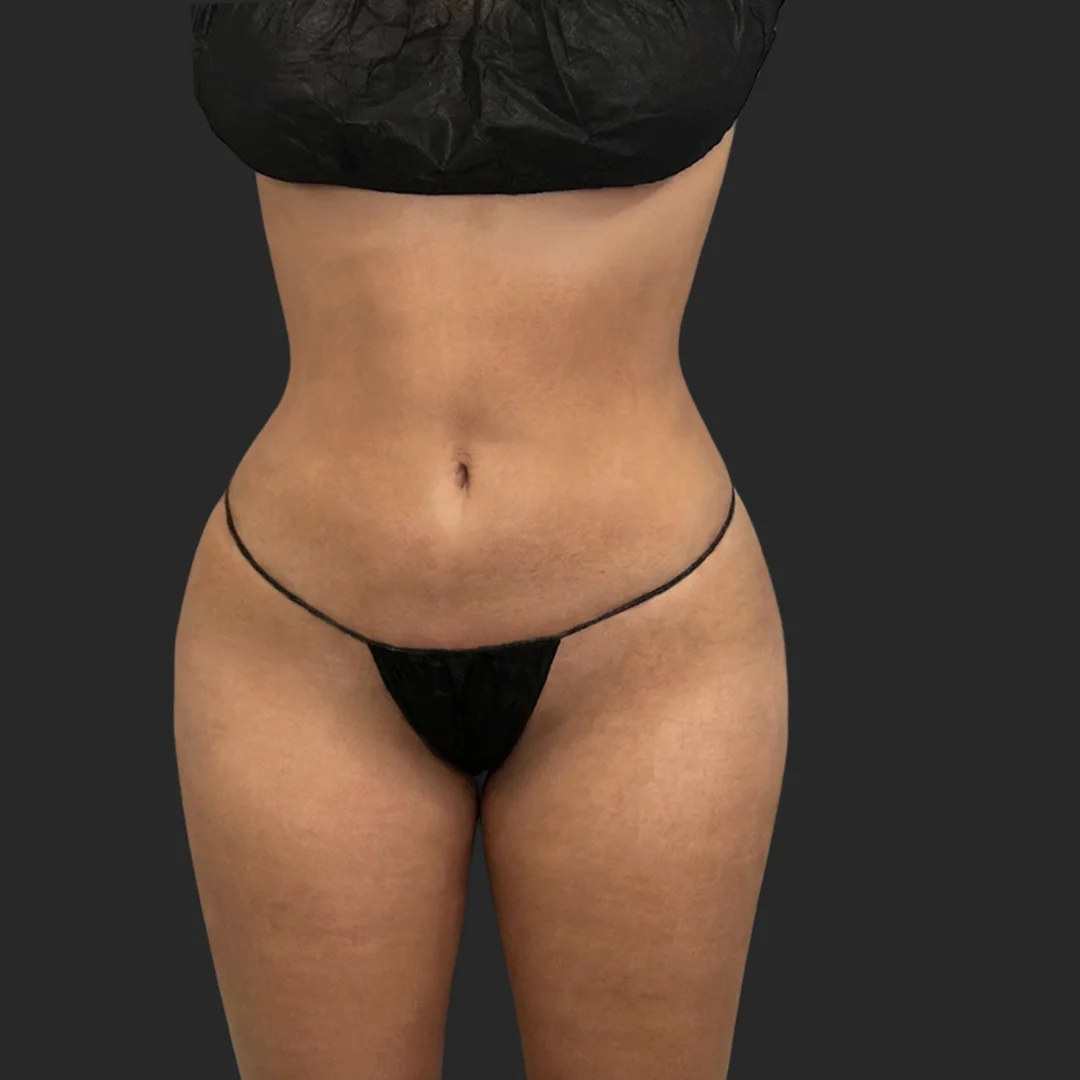 Bbl result at Be That Beautiful™ Plastic Surgery