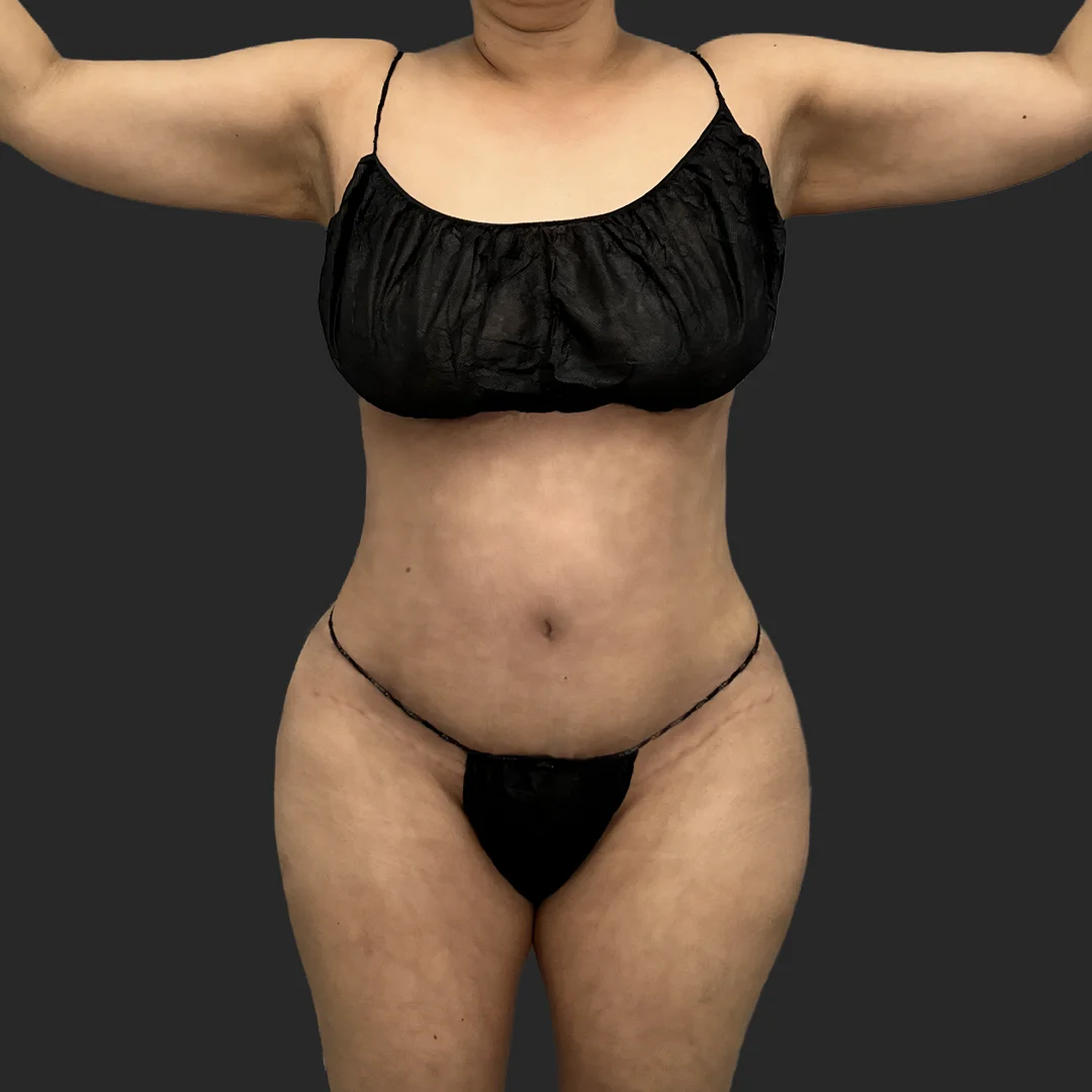 Tummy Tuck result at Be That Beautiful™ Plastic Surgery