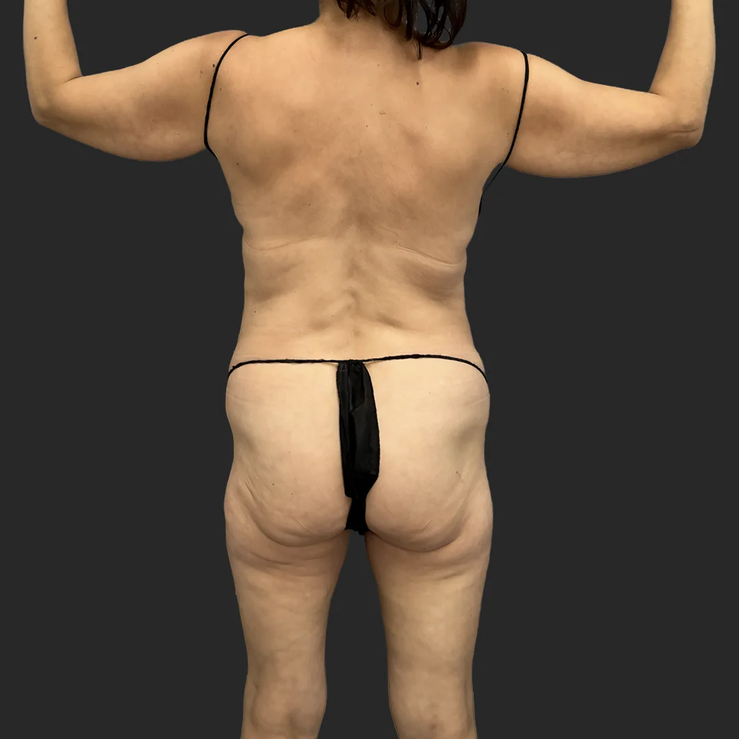 Tummy Tuck result at Be That Beautiful™ Plastic Surgery